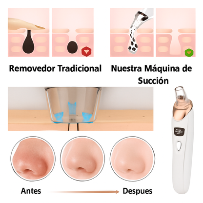 Removedor  de espinillas y limpia poros